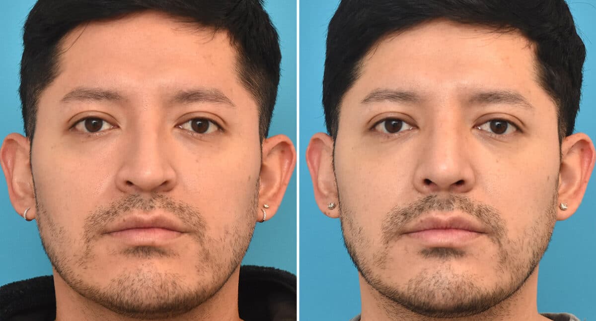 Rhinoplasty Before and After Photos in Philadelphia, PA, Patient 1343