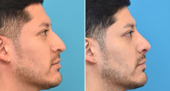 Rhinoplasty Before and After Photos in Philadelphia, PA, Patient 1343