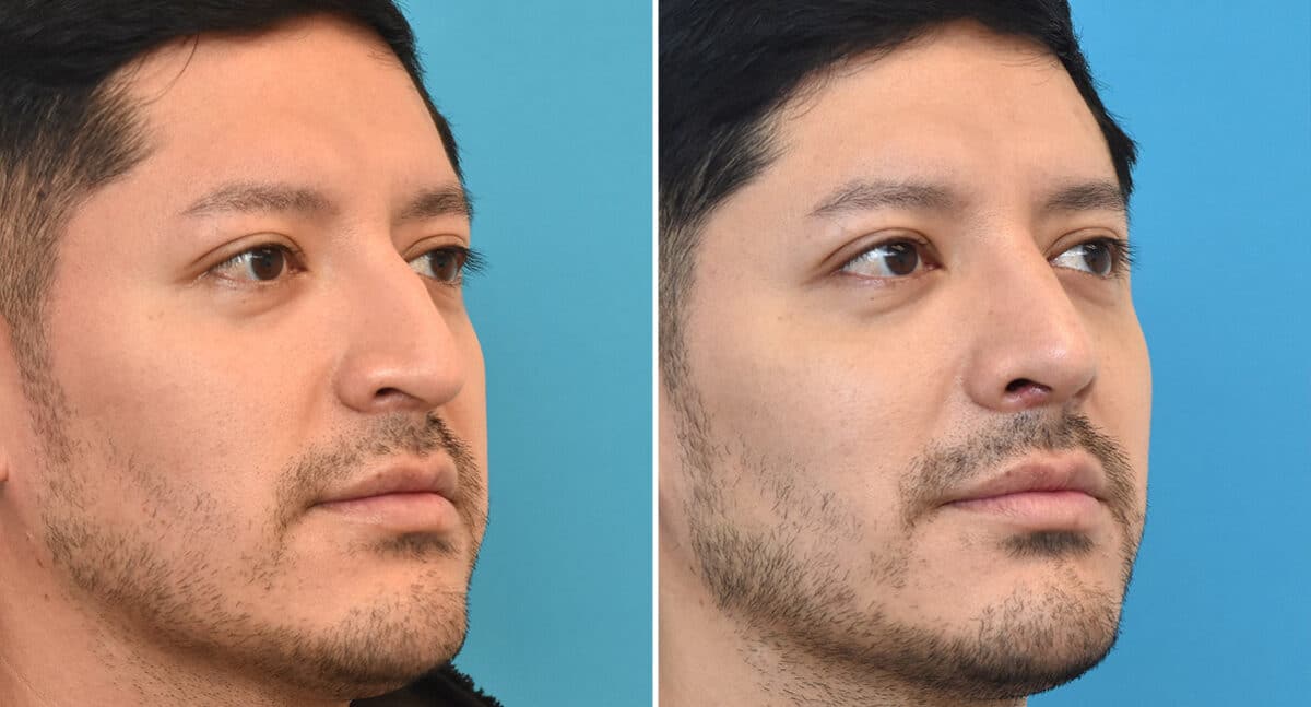 Rhinoplasty Before and After Photos in Philadelphia, PA, Patient 1343