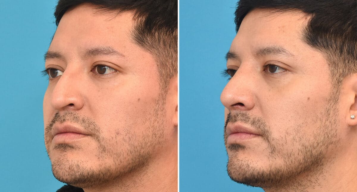 Rhinoplasty Before and After Photos in Philadelphia, PA, Patient 1343