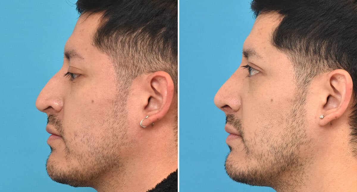 Rhinoplasty Before and After Photos in Philadelphia, PA, Patient 1343
