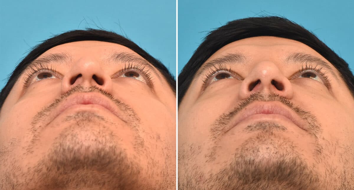 Rhinoplasty Before and After Photos in Philadelphia, PA, Patient 1343