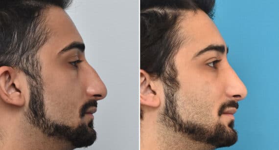 Rhinoplasty Before and After Photos in Philadelphia, PA, Patient 1378