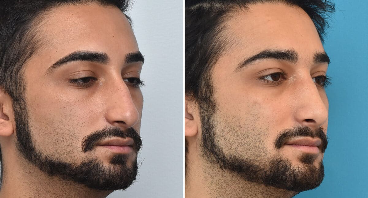 Rhinoplasty Before and After Photos in Philadelphia, PA, Patient 1378