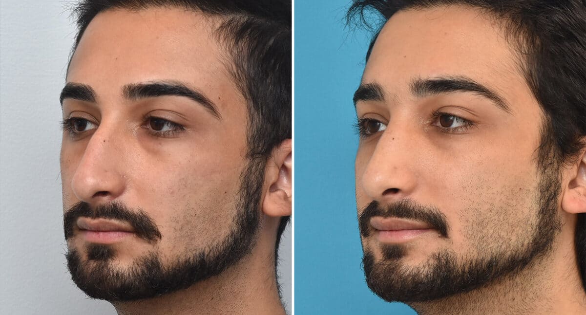 Rhinoplasty Before and After Photos in Philadelphia, PA, Patient 1378