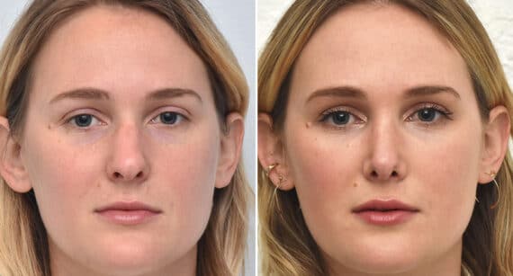 Rhinoplasty Before and After Photos in Philadelphia, PA, Patient 1399