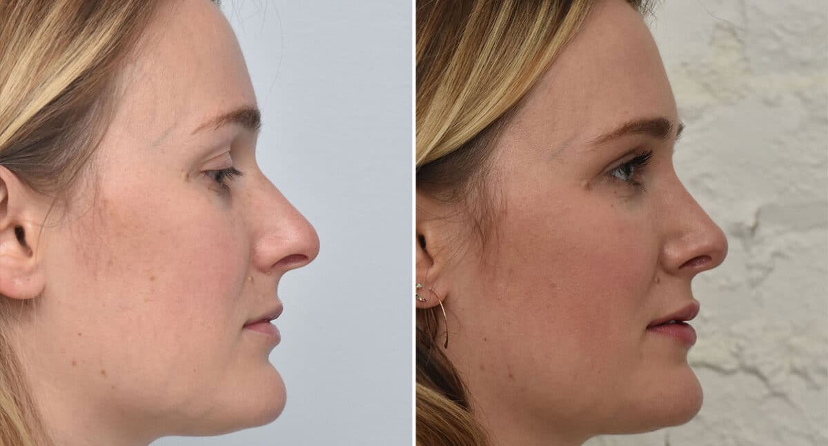 Rhinoplasty Before and After Photos in Philadelphia, PA, Patient 1399