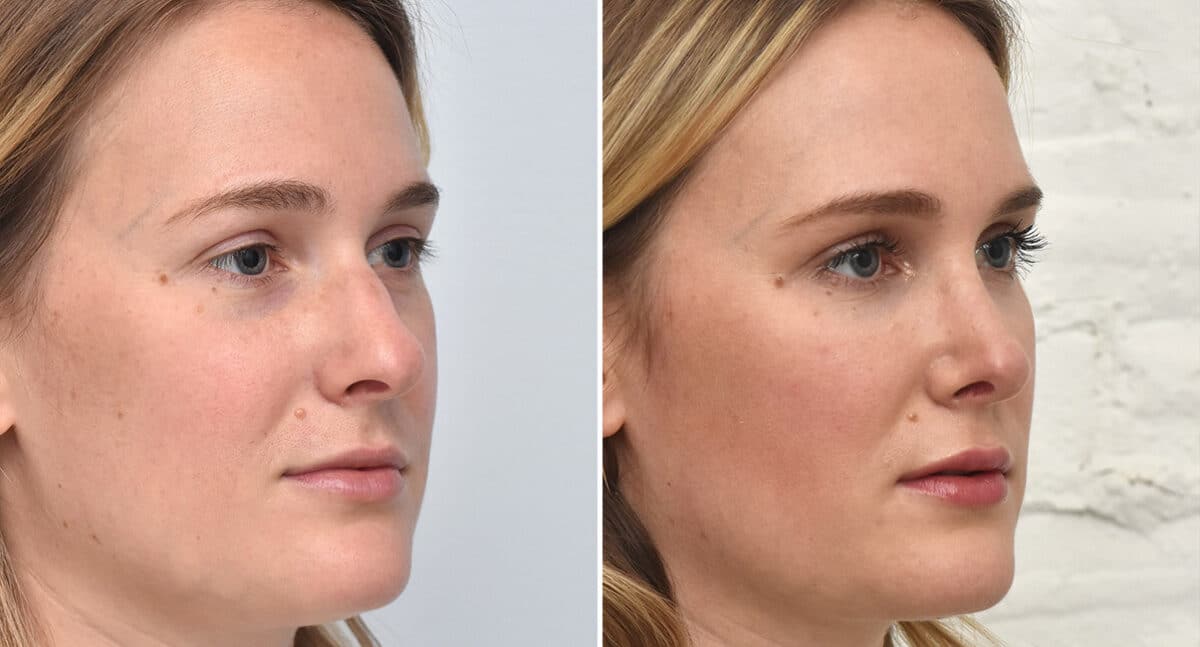 Rhinoplasty Before and After Photos in Philadelphia, PA, Patient 1399