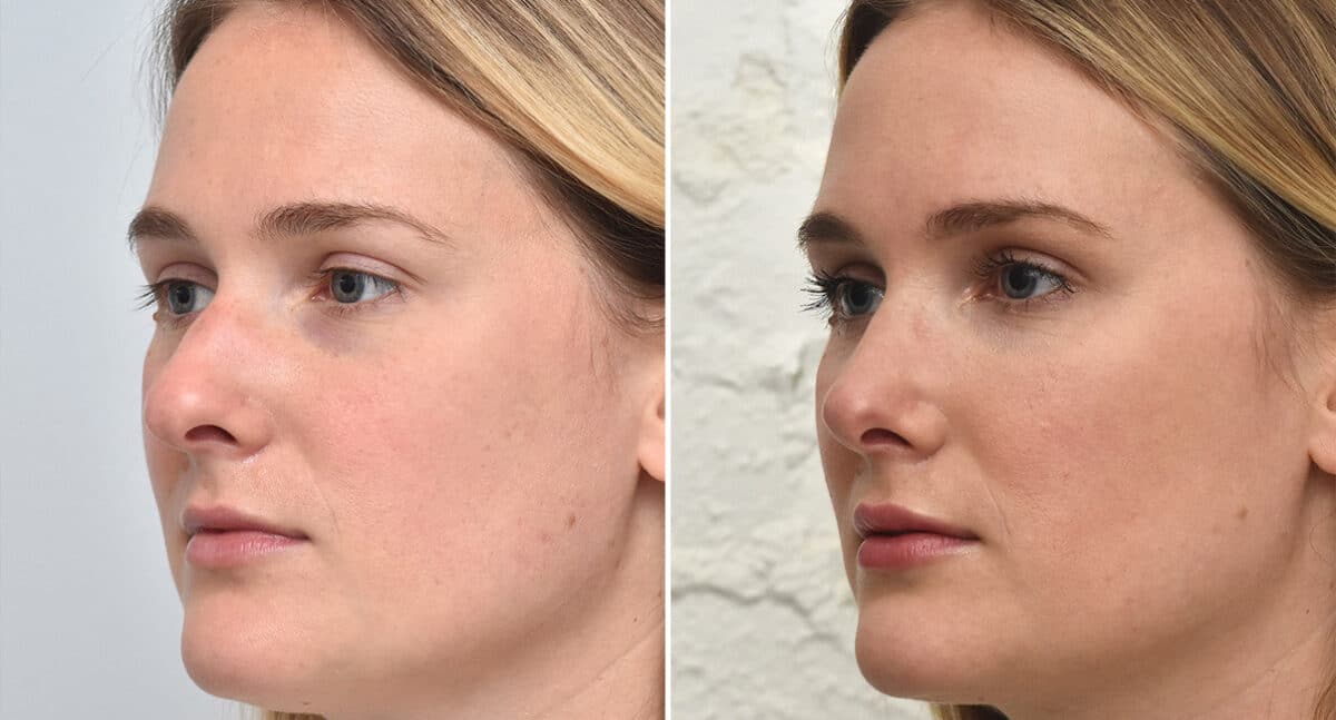 Rhinoplasty Before and After Photos in Philadelphia, PA, Patient 1399