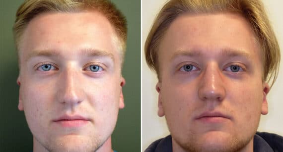 Rhinoplasty Before and After Photos in Philadelphia, PA, Patient 1412