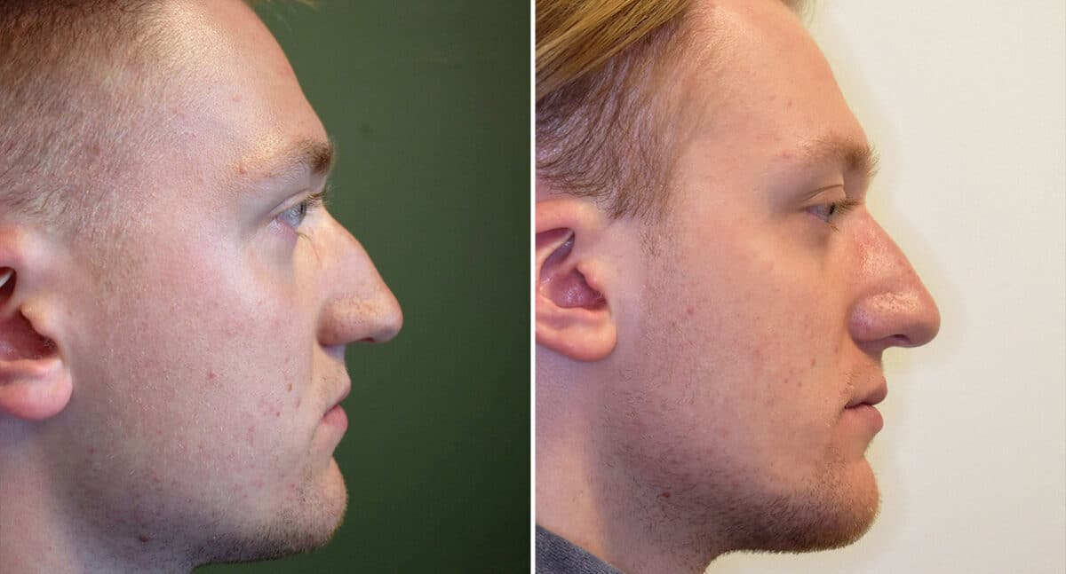 Rhinoplasty Before and After Photos in Philadelphia, PA, Patient 1412