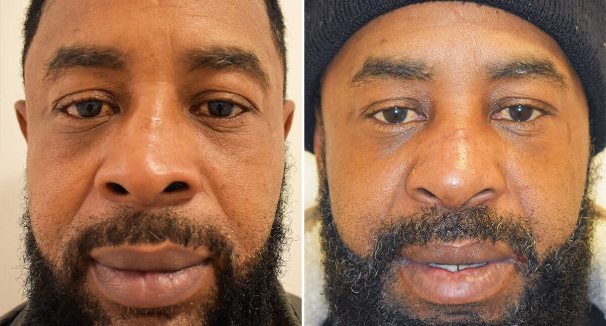 Patient 1419, Rhinoplasty Before and After Photos Rhinoplasty Before and After Photos in Philadelphia, PA, Patient 1419