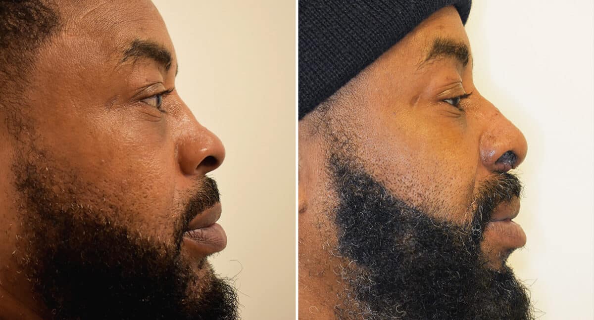 Patient 1419, Rhinoplasty Before and After Photos Rhinoplasty Before and After Photos in Philadelphia, PA, Patient 1419