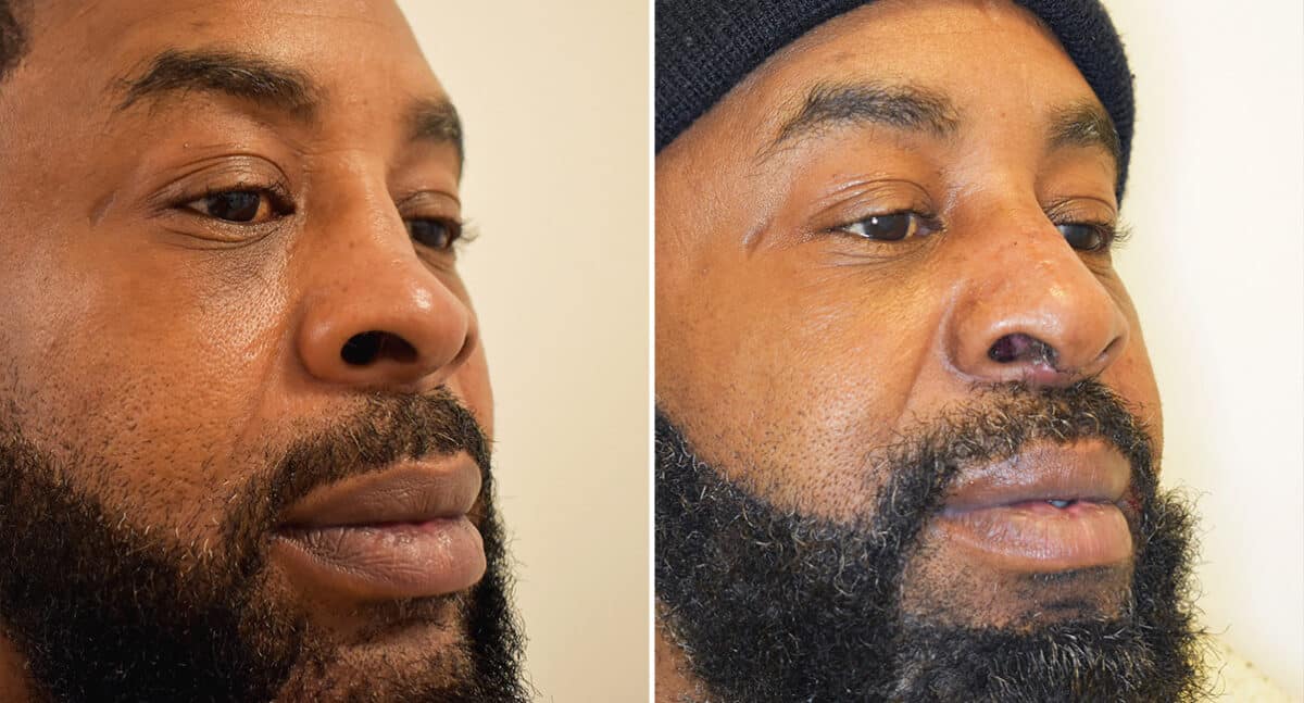 Patient 1419, Rhinoplasty Before and After Photos Rhinoplasty Before and After Photos in Philadelphia, PA, Patient 1419