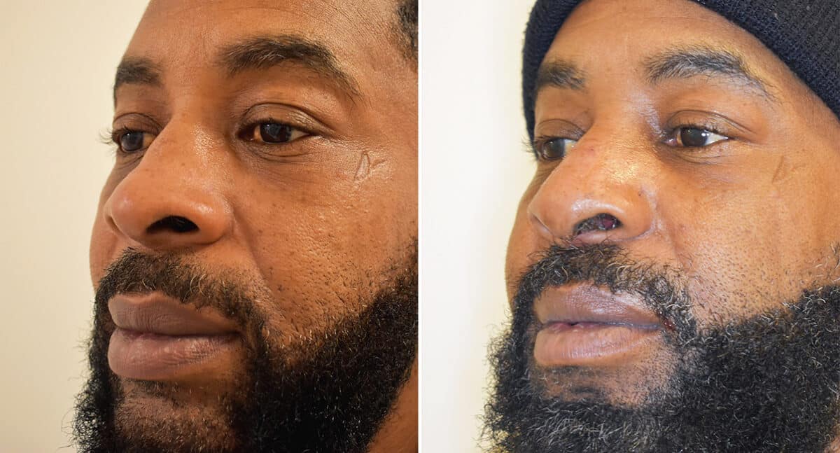 Patient 1419, Rhinoplasty Before and After Photos Rhinoplasty Before and After Photos in Philadelphia, PA, Patient 1419