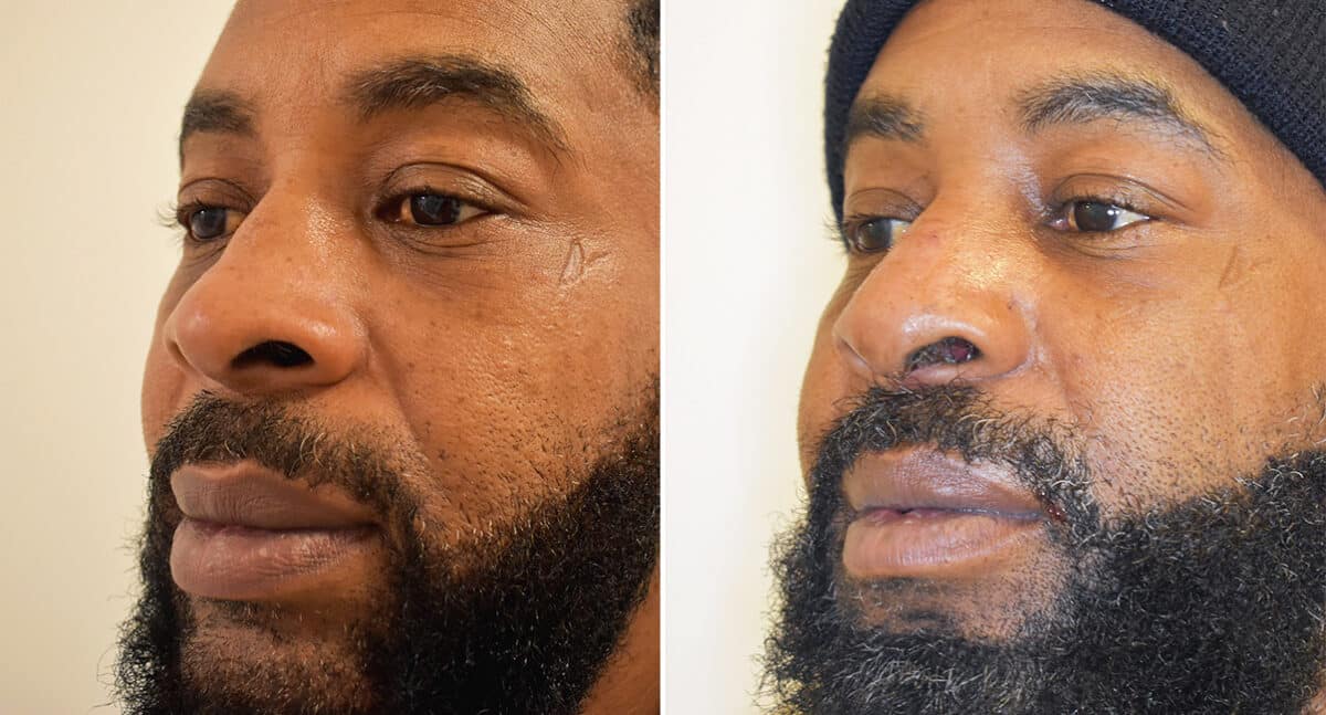 Rhinoplasty Before and After Photos in Philadelphia, PA, Patient 1419