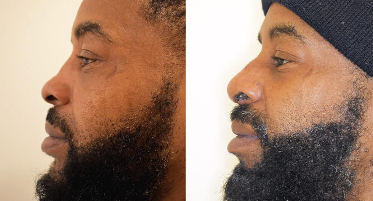 Patient 1419, Rhinoplasty Before and After Photos Rhinoplasty Before and After Photos in Philadelphia, PA, Patient 1419