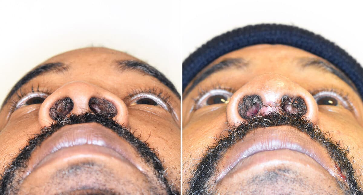 Patient 1419, Rhinoplasty Before and After Photos Rhinoplasty Before and After Photos in Philadelphia, PA, Patient 1419
