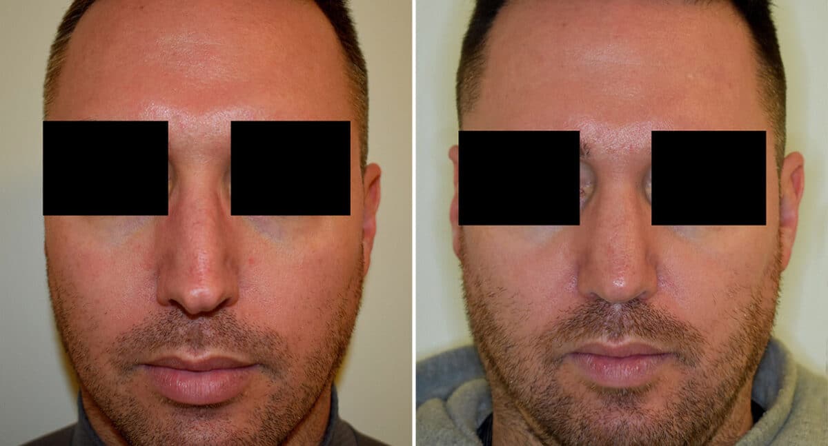 Rhinoplasty Before and After Photos in Philadelphia, PA, Patient 1438