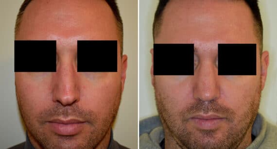 Rhinoplasty Before and After Photos in Philadelphia, PA, Patient 1438