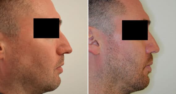 Rhinoplasty Before and After Photos in Philadelphia, PA, Patient 1438