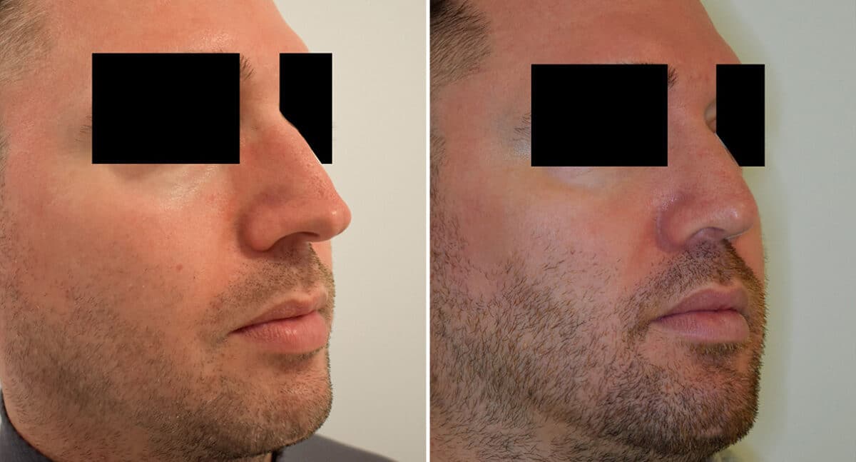 Rhinoplasty Before and After Photos in Philadelphia, PA, Patient 1438