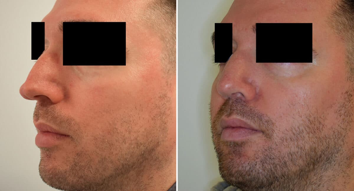 Rhinoplasty Before and After Photos in Philadelphia, PA, Patient 1438