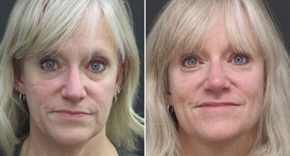 Rhinoplasty Before and After Photos in Princeton, NJ, Patient 526