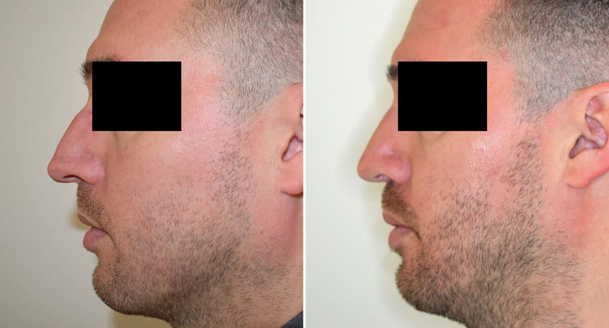 Rhinoplasty Before and After Photos in Philadelphia, PA, Patient 1438