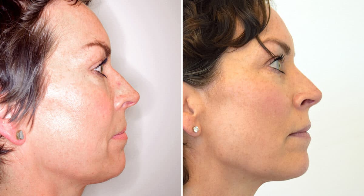 Rhinoplasty Before and After Photos in Philadelphia, PA, Patient 1457