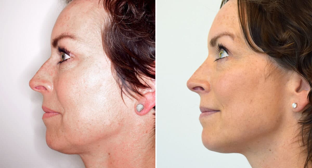 Rhinoplasty Before and After Photos in Philadelphia, PA, Patient 1457