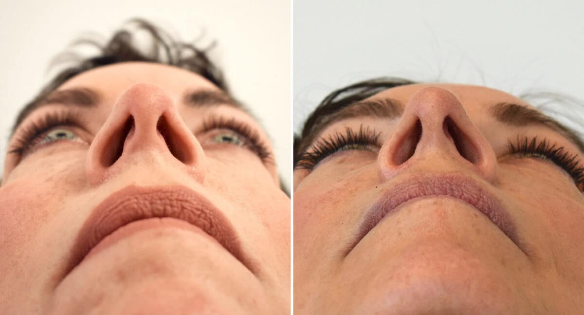 Rhinoplasty Before and After Photos in Philadelphia, PA, Patient 1457