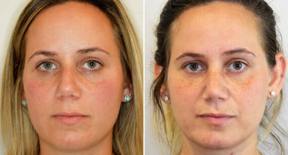 Rhinoplasty Before and After Photos in Philadelphia, PA, Patient 1473