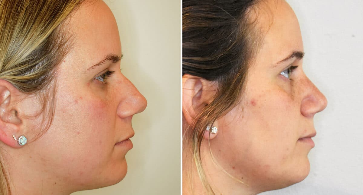 Rhinoplasty Before and After Photos in Philadelphia, PA, Patient 1473