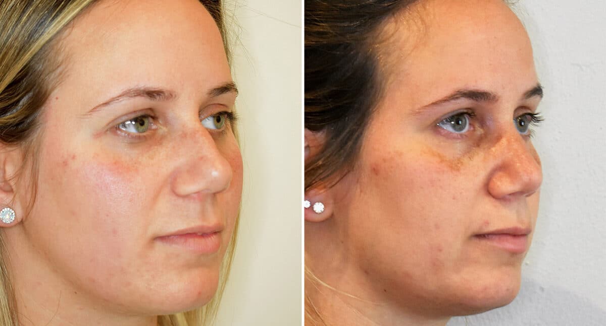 Rhinoplasty Before and After Photos in Philadelphia, PA, Patient 1473