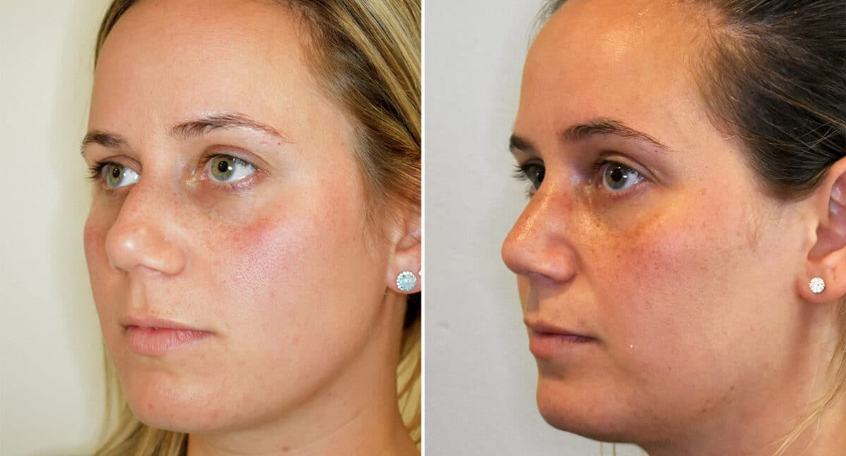 Rhinoplasty Before and After Photos in Philadelphia, PA, Patient 1473