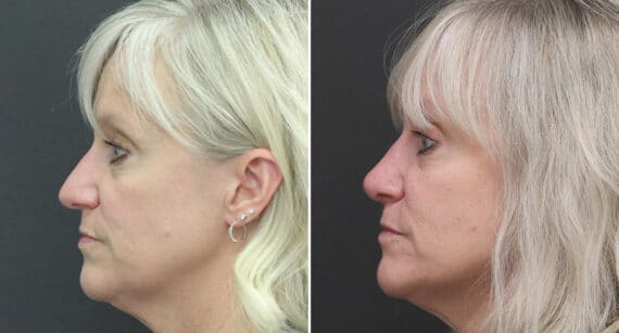 Rhinoplasty Before and After Photos in Princeton, NJ, Patient 526