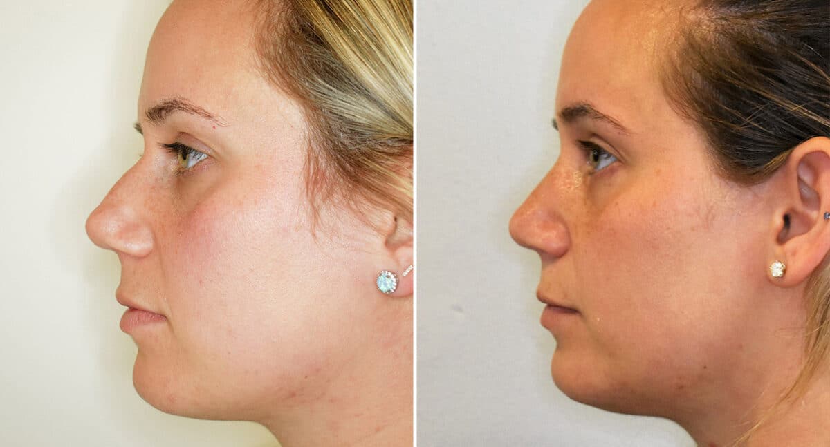 Rhinoplasty Before and After Photos in Philadelphia, PA, Patient 1473