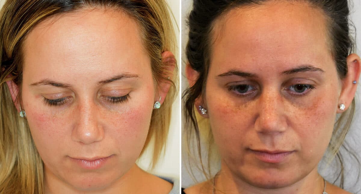 Rhinoplasty Before and After Photos in Philadelphia, PA, Patient 1473