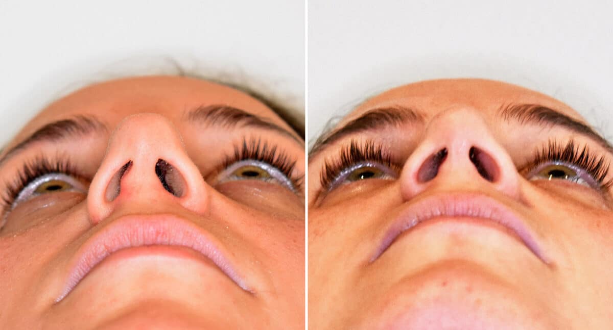 Rhinoplasty Before and After Photos in Philadelphia, PA, Patient 1473