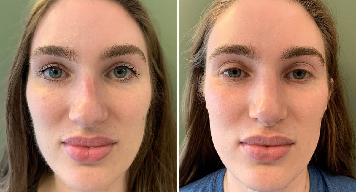 Rhinoplasty Before and After Photos in Philadelphia, PA, Patient 1495