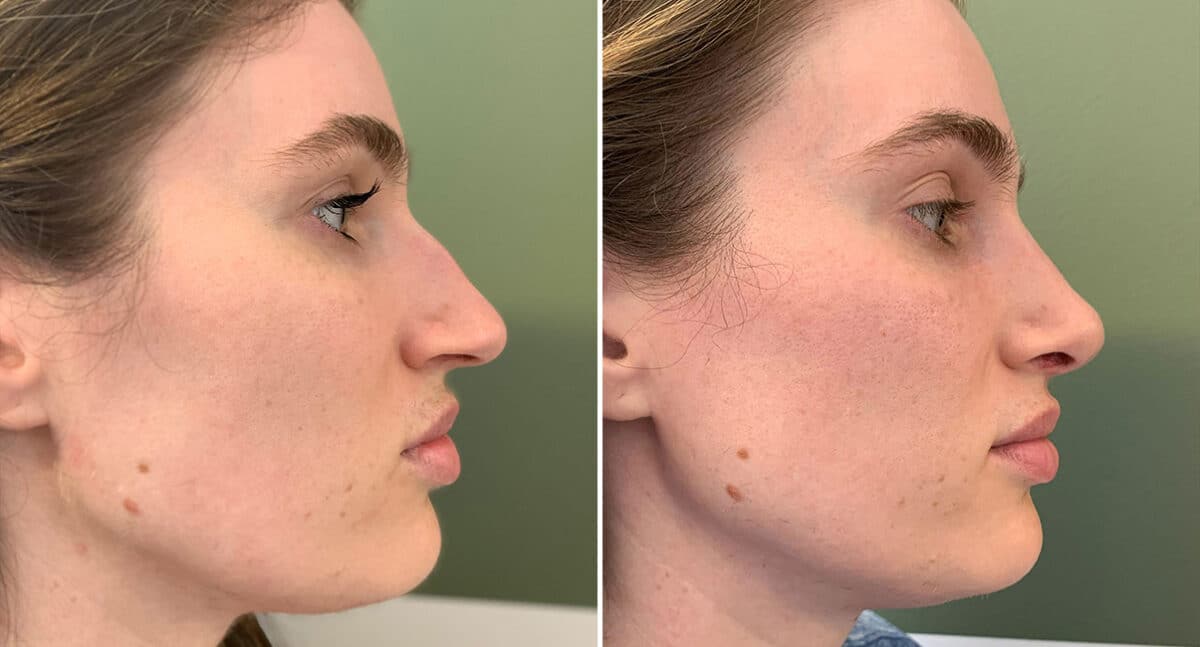 Rhinoplasty Before and After Photos in Philadelphia, PA, Patient 1495