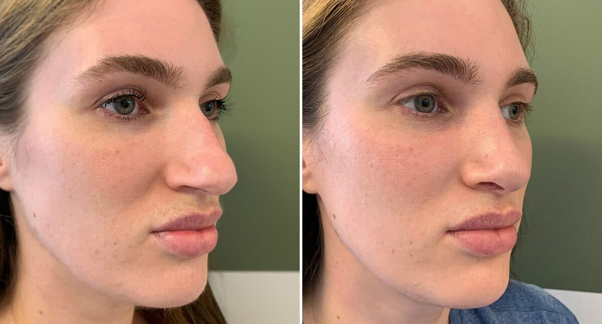 Rhinoplasty Before and After Photos in Philadelphia, PA, Patient 1495