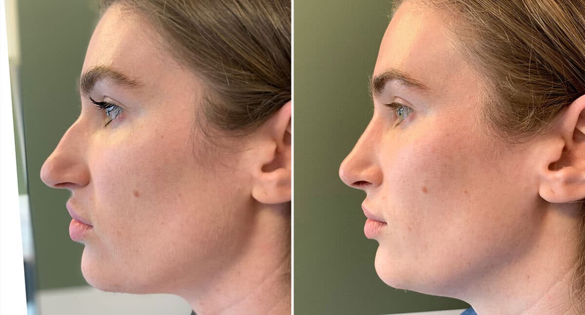 Rhinoplasty Before and After Photos in Philadelphia, PA, Patient 1495