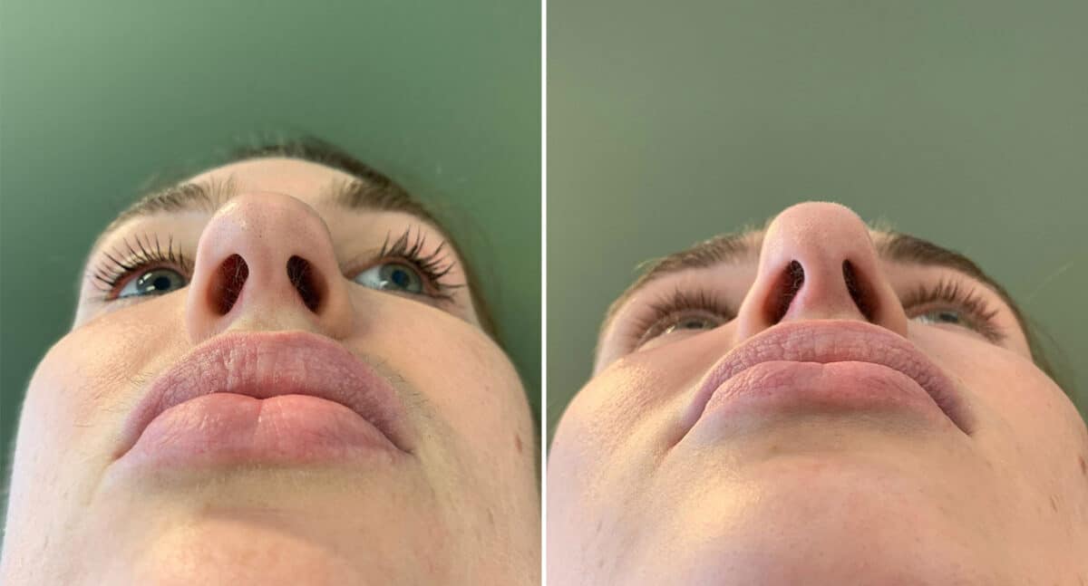 Rhinoplasty Before and After Photos in Philadelphia, PA, Patient 1495