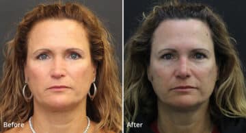 Rhinoplasty Before and After Photos in Princeton, NJ, Patient 536