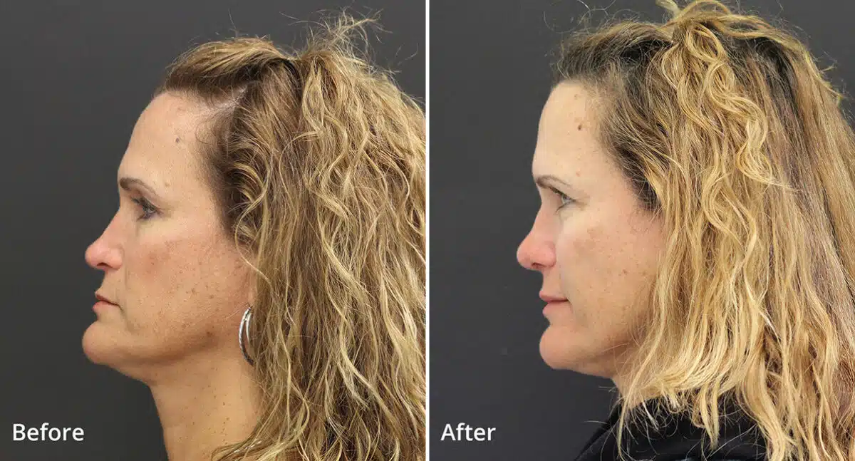 Rhinoplasty Before and After Photos in Princeton, NJ, Patient 536