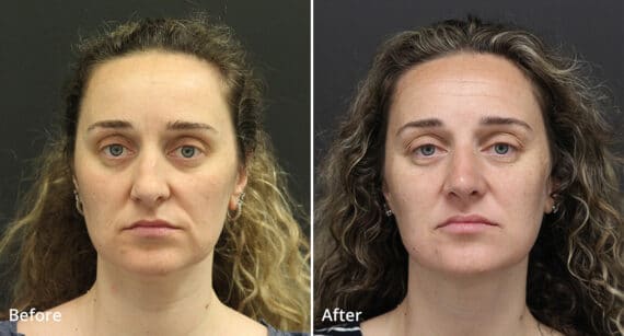 Rhinoplasty Before and After Photos in Princeton, NJ, Patient 547