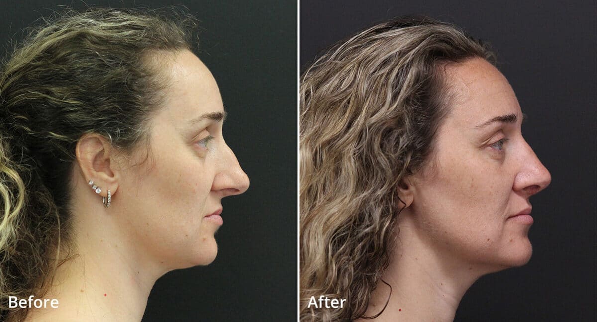 Rhinoplasty Before and After Photos in Princeton, NJ, Patient 547