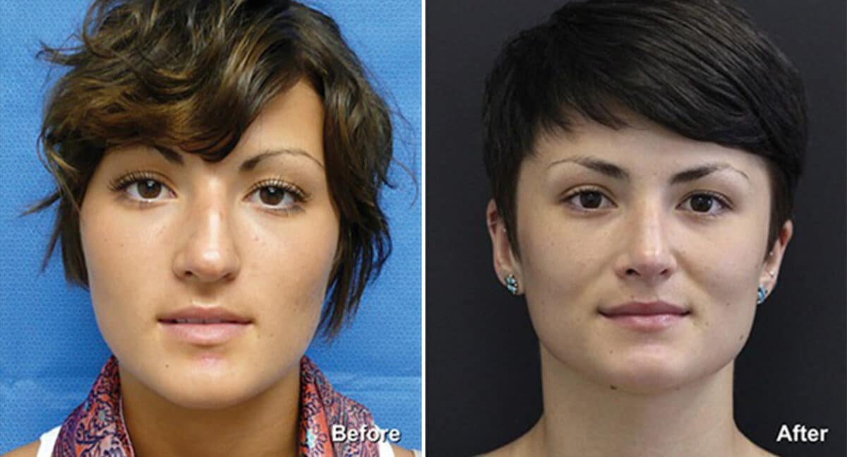 Rhinoplasty Before and After Photos in Princeton, NJ, Patient 554